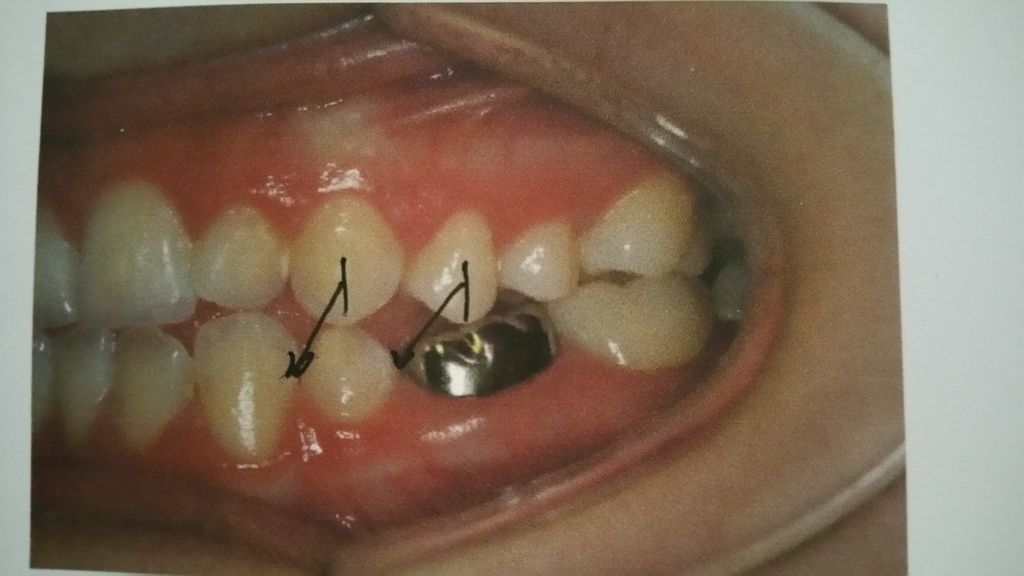 Braces and Palate Expander at 20 Years Old Metal Mouth Message Board